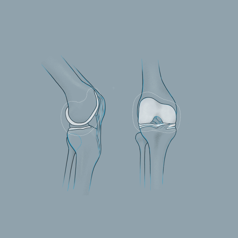 Zeichnung eines Knies & der Knorpel