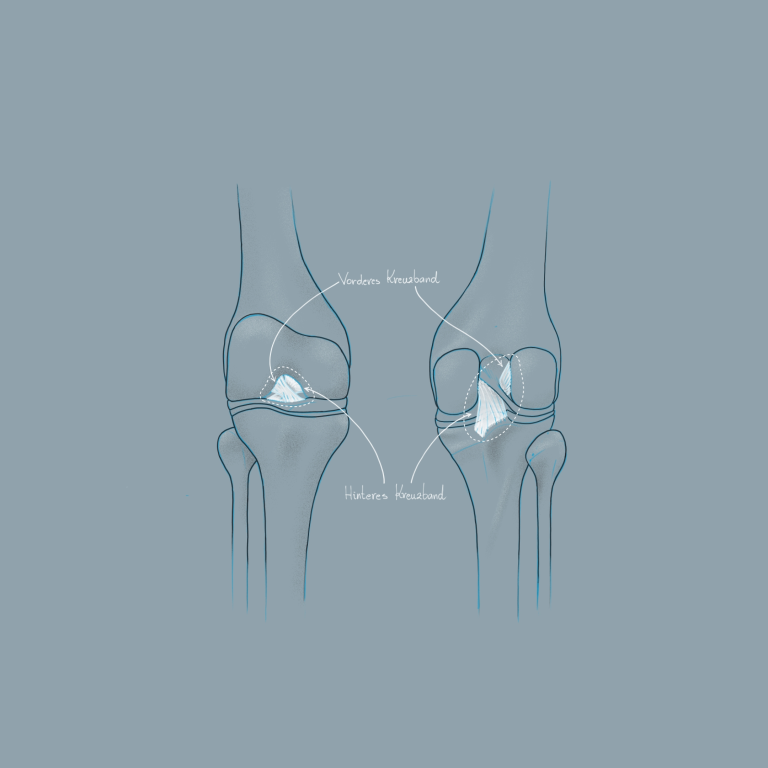Zeichnung eines Knies & der Kreuzbänder