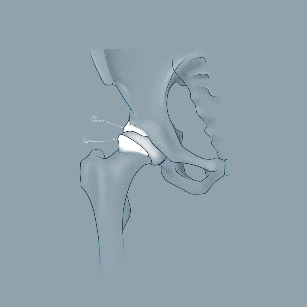 Zeichnung einer Hüfte mit Impingement