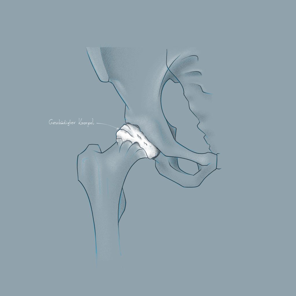 Zeichnung einer Hüfte mit Coxarthrose
