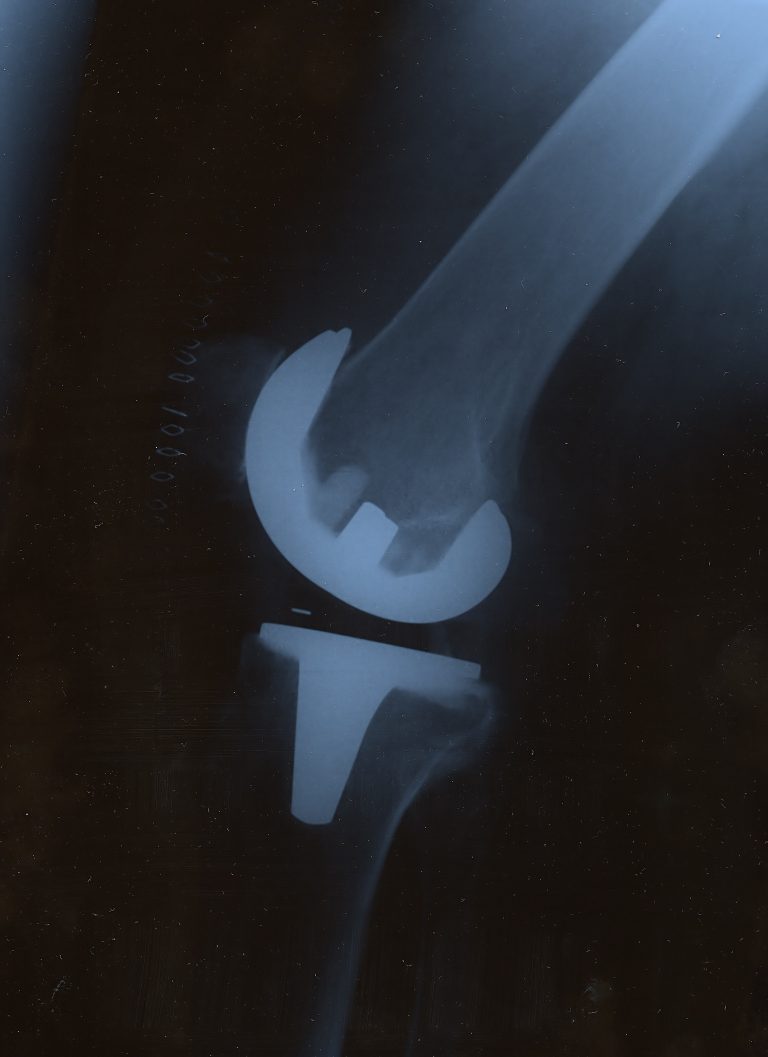 Artificial Knee Vienna Knee Specialist Dr. Martin Gruber