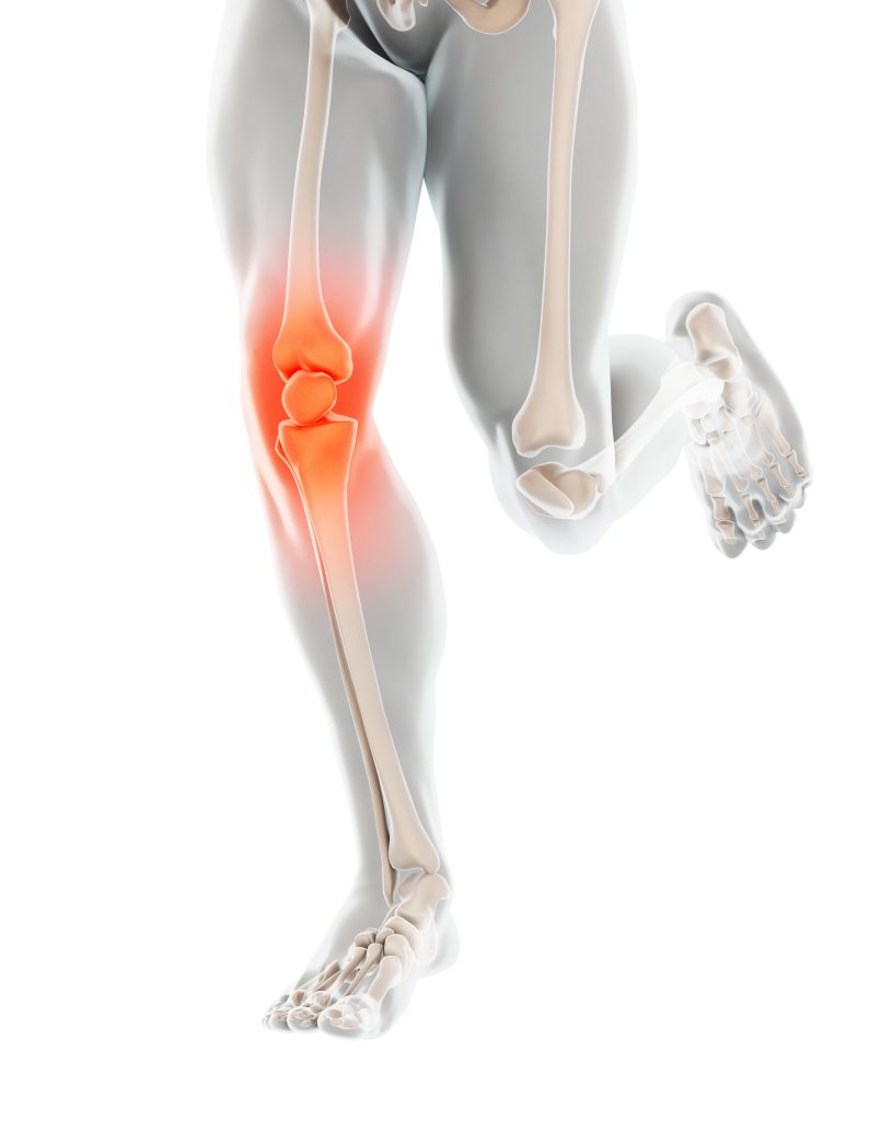 Schmerzendes Knie während des Laufens - Runners Knee