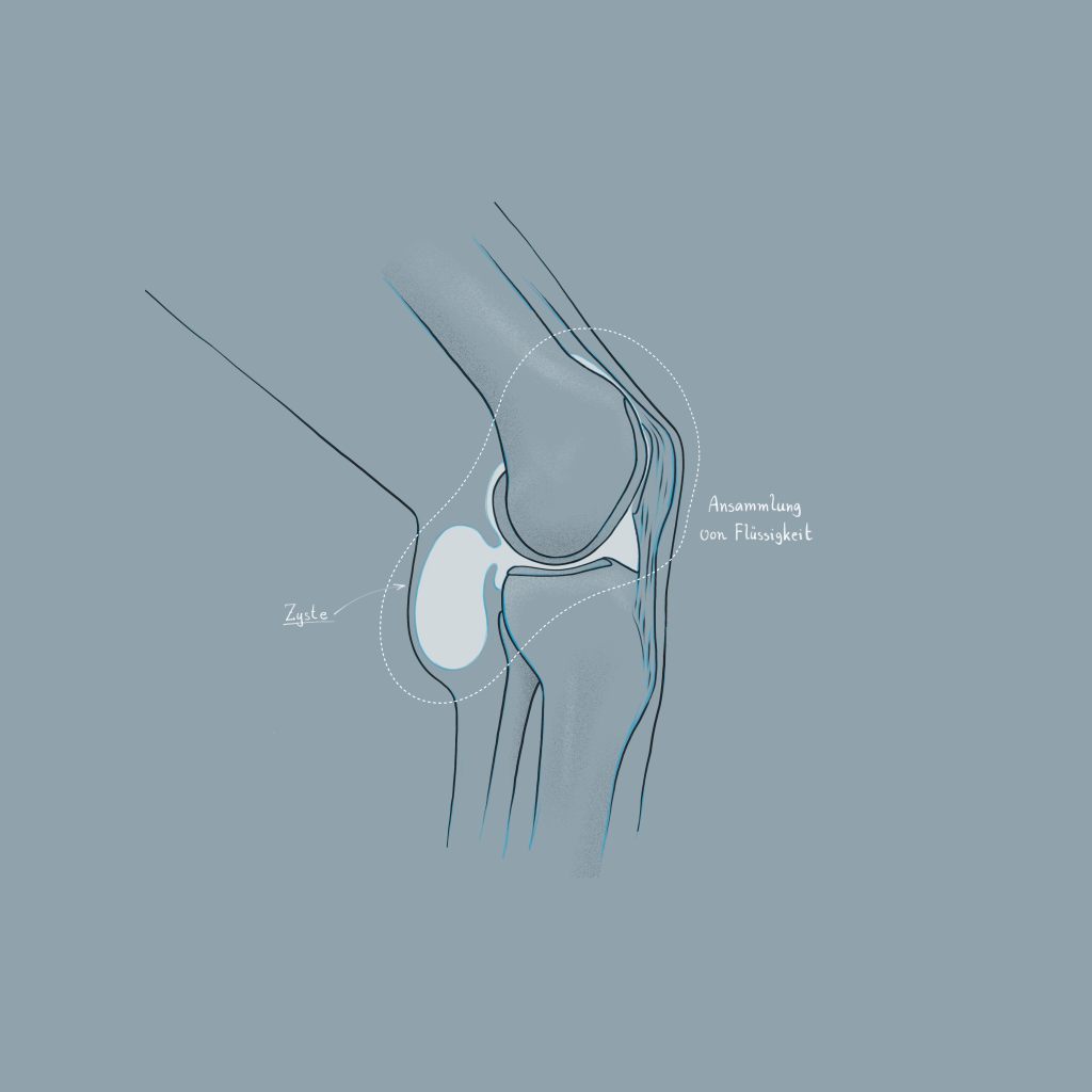 Zeichnung einer Bakerzyste