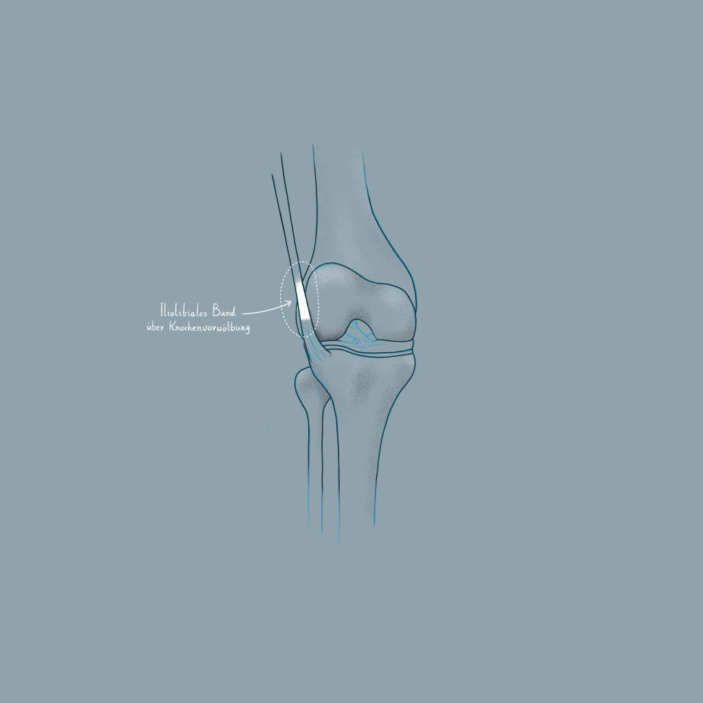 Zeichnung eines Runner's Knee