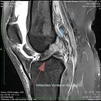 Case of the Week - Verletzung des vordere Kreuzbandes & Wurzelläsion