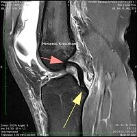 Case of the Week - Verletzung des vordere Kreuzbandes & Wurzelläsion