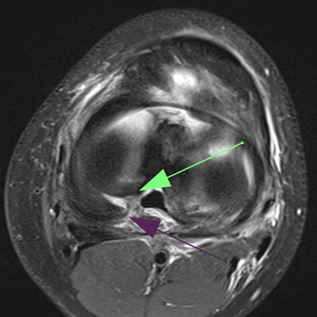 Case of the Week: Verletzung des vordere Kreuzbandes & Wurzelläsion