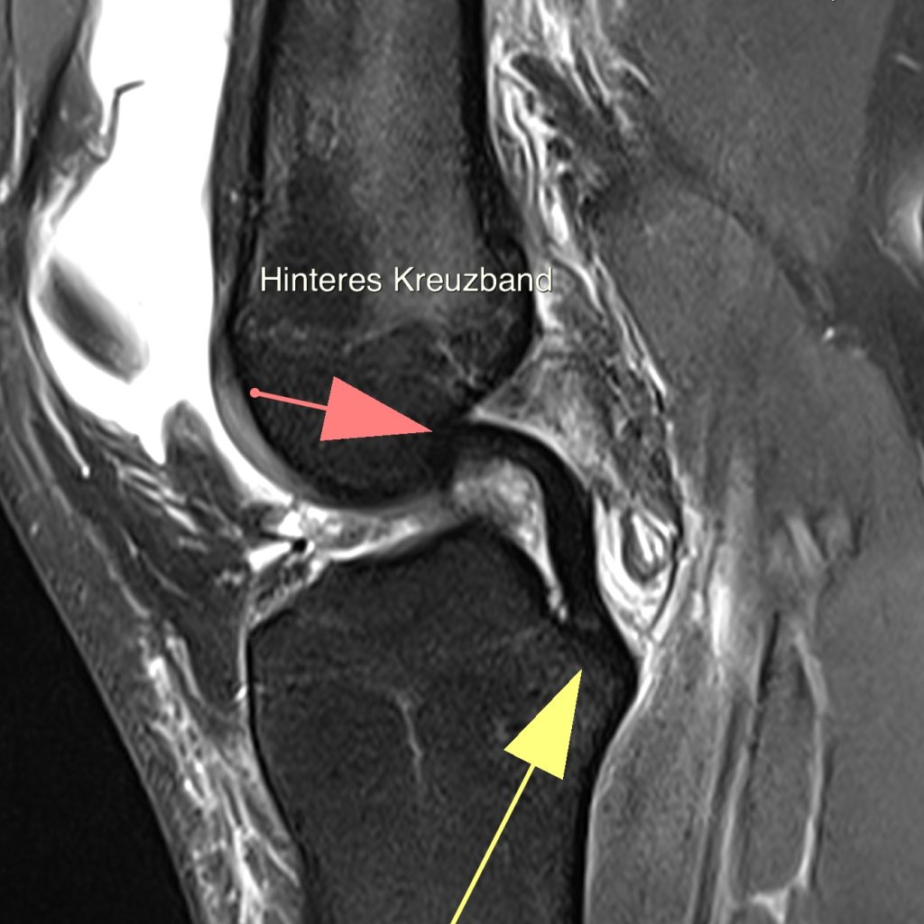 Case of the Week: Verletzung des vordere Kreuzbandes & Wurzelläsion