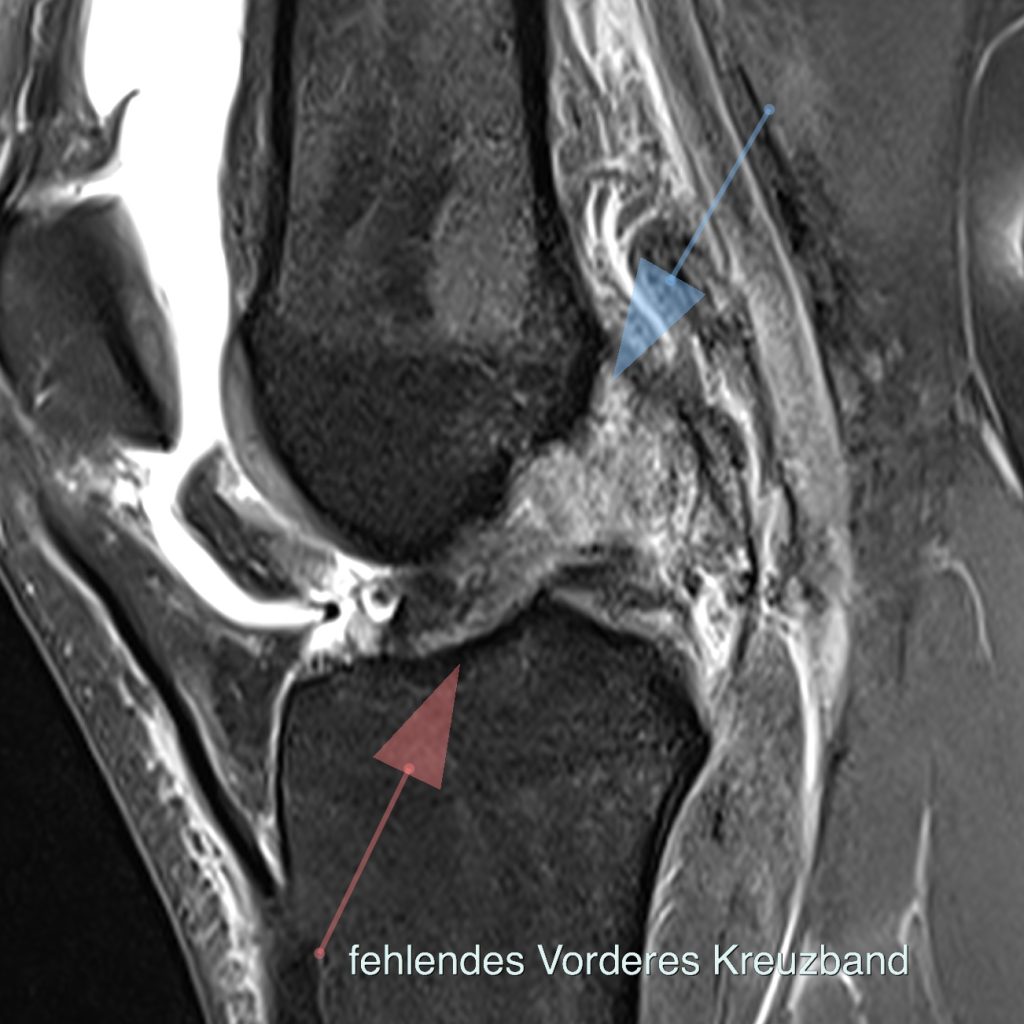 Case of the Week: Verletzung des vordere Kreuzbandes & Wurzelläsion