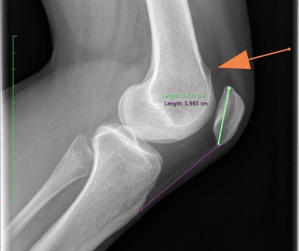 Case of the Week: Habituelle Patellaluxation - Trochleadysplasie