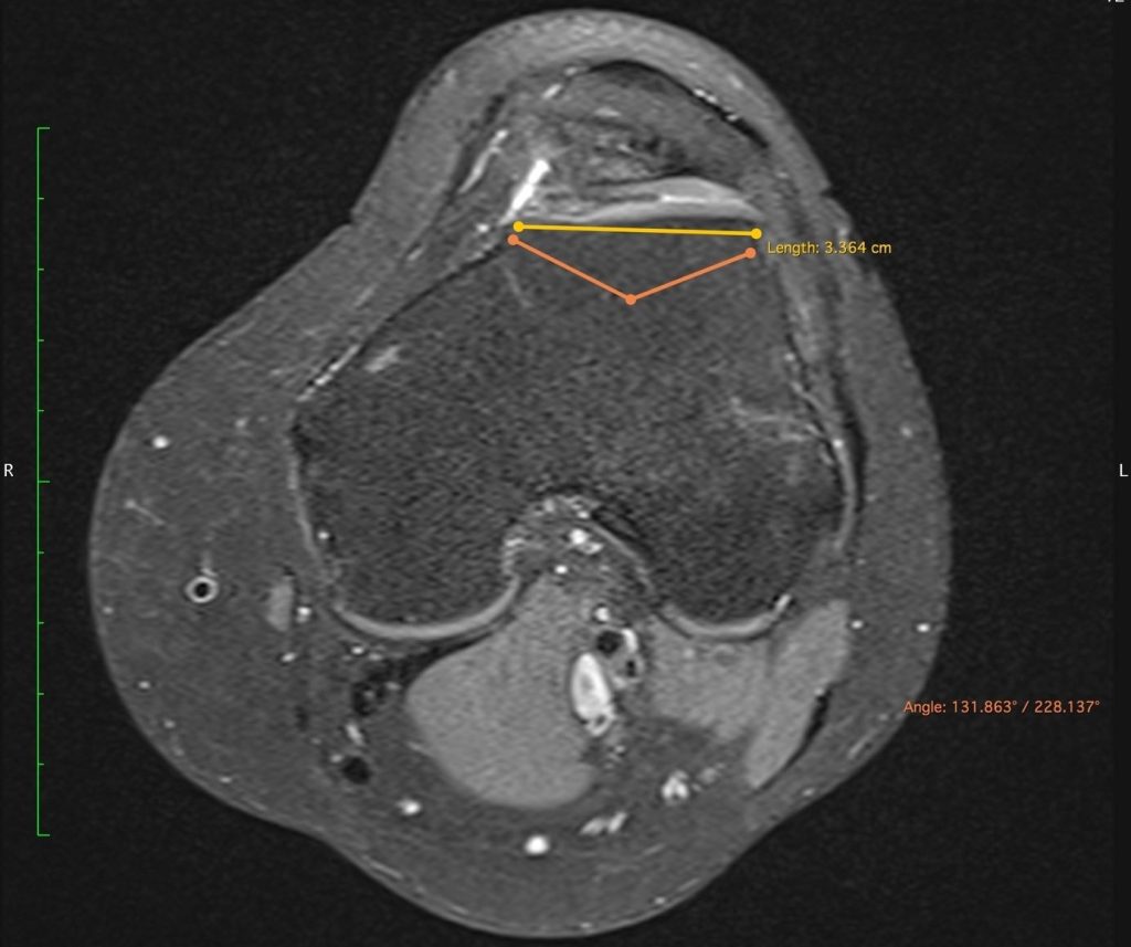 Case of the Week: Habituelle Patellaluxation - Trochleadysplasie