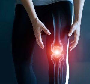 Eine herausgesprungene Kniescheibe hat das Risiko die Muskulatur und das Gelenk verletzen. Ein Knie eines betroffenen Menschen ist abgebildet nach einer Sport-Verletzung.