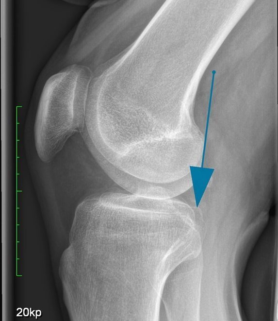 Case of the Week: Hintere Kreuzbandruptur