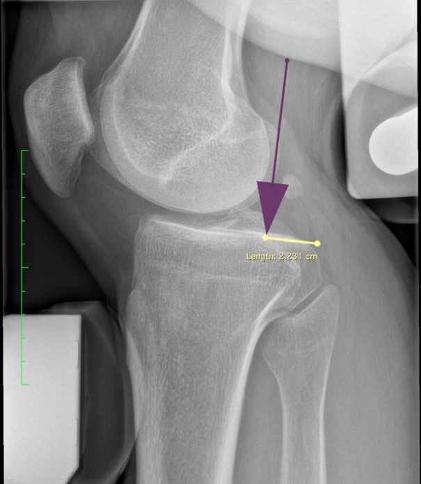 Case of the Week: Hintere Kreuzbandruptur