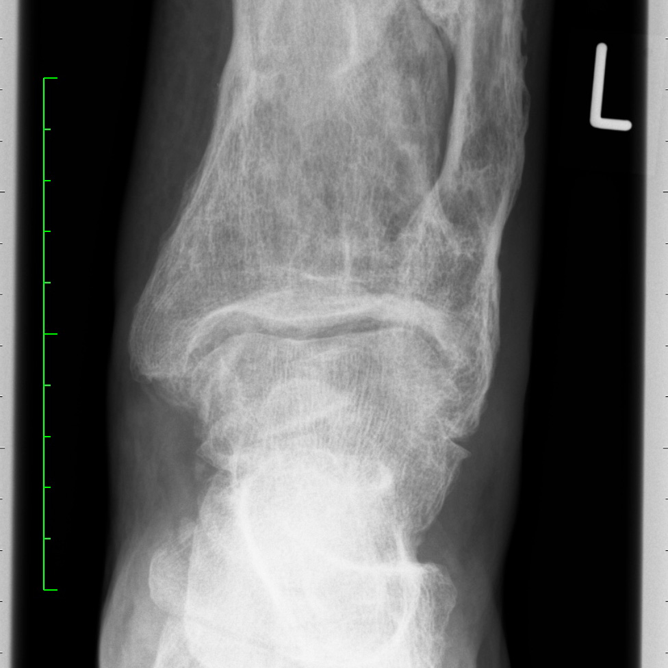 Case of the Week: Sprunggelenksendoprothese