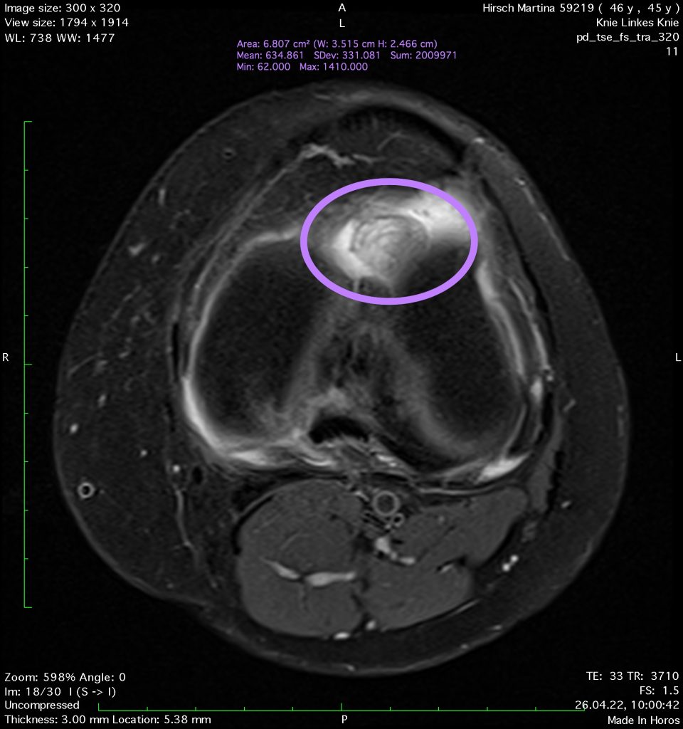 Case of the Week: Zyklopssyndrom