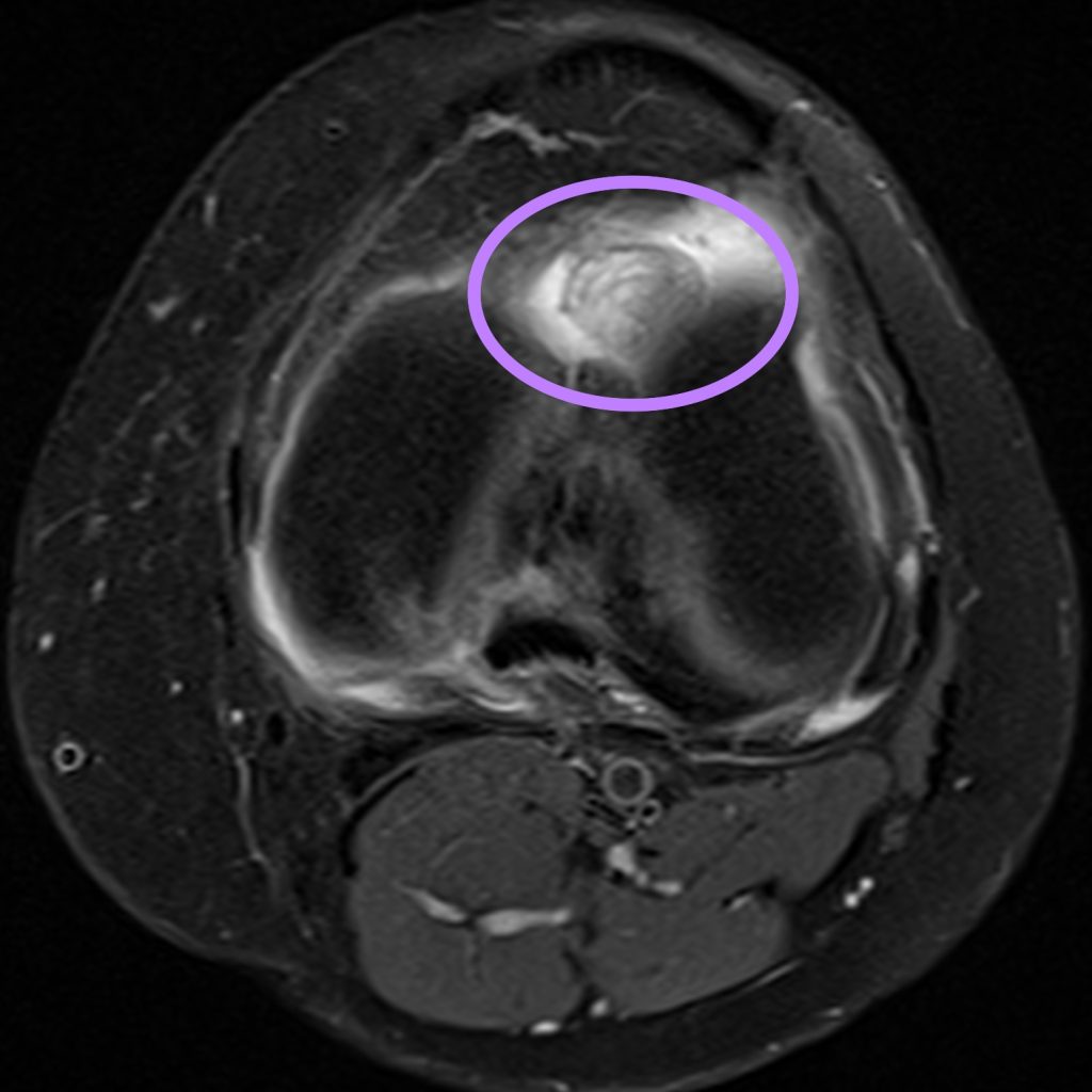 Case of the Week: Zyklopssyndrom