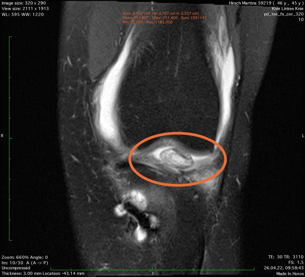 Case of the Week: Zyklopssyndrom