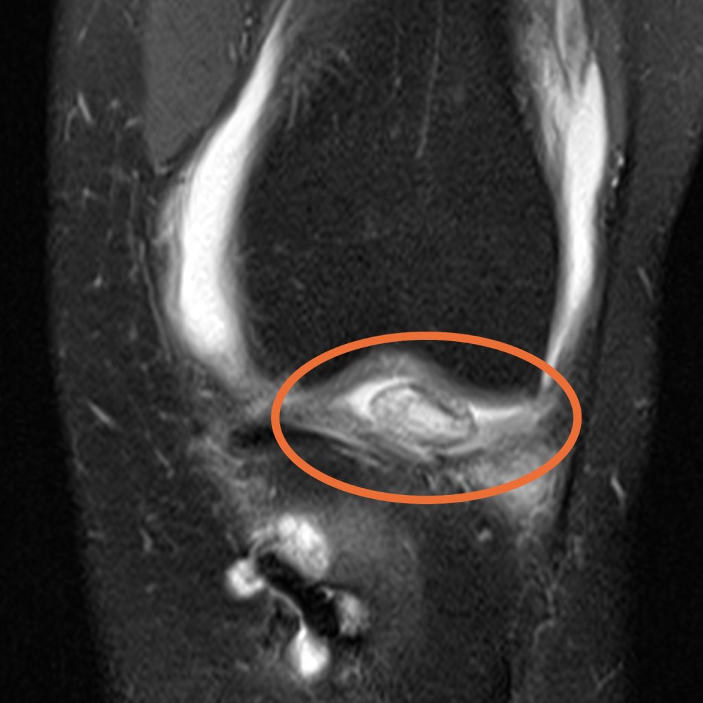 Case of the Week: Zyklopssyndrom