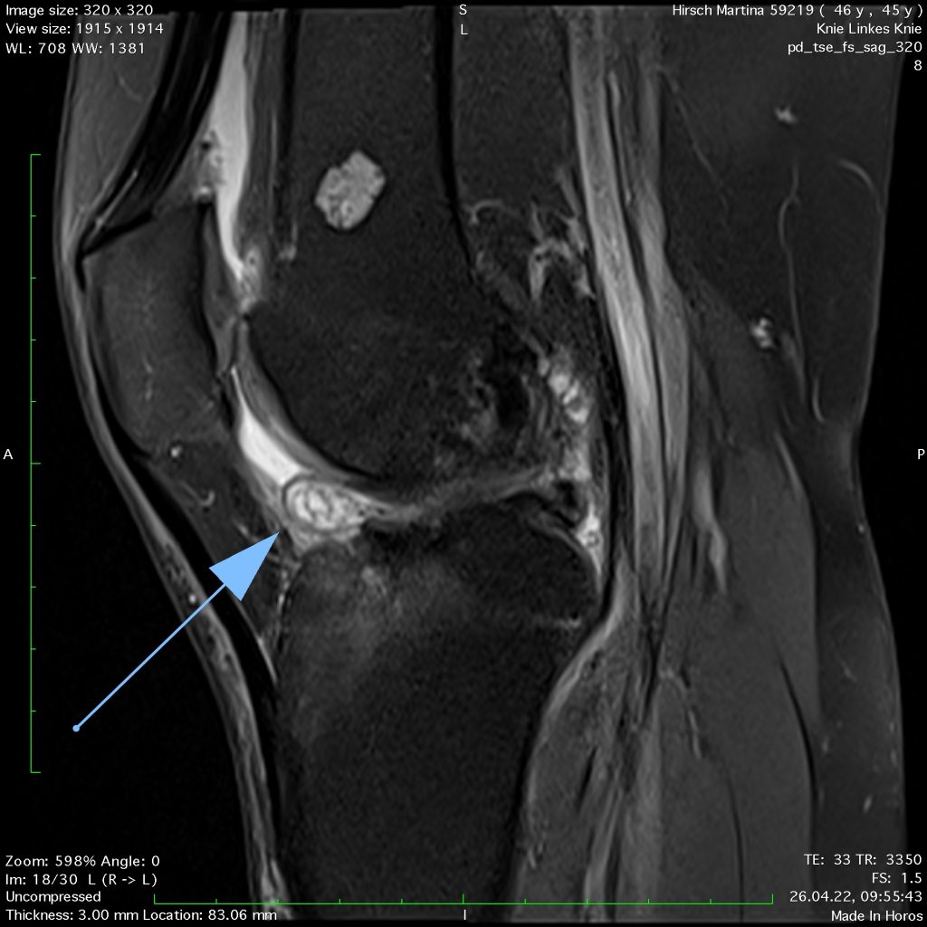 Case of the Week: Zyklopssyndrom