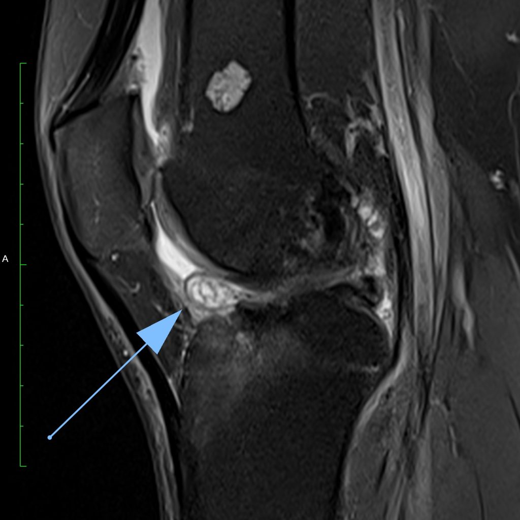 Case of the Week: Zyklopssyndrom