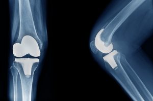 Röntgenbild eines Knies mit künstlichem Kniegelenks