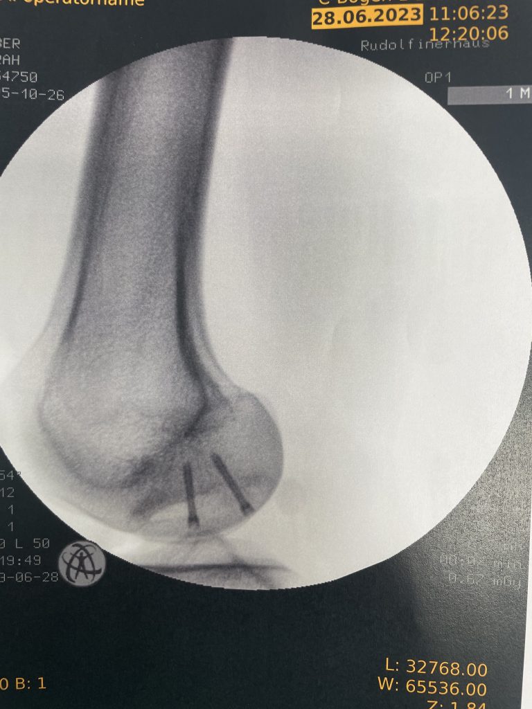 Case of the Week: Osteochondritis Dissecans