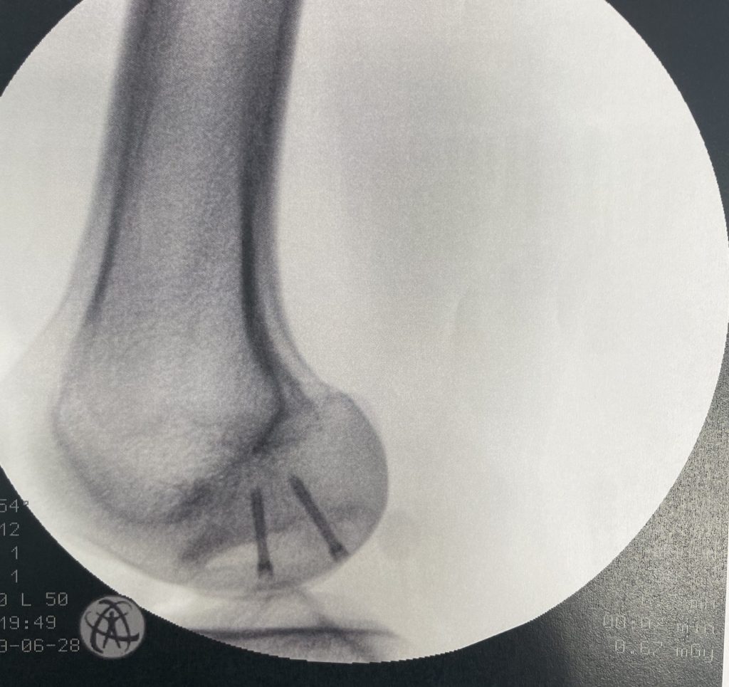 Case of the Week: Osteochondritis Dissecans