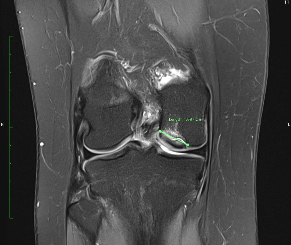 Case of the Week: Osteochondritis Dissecans