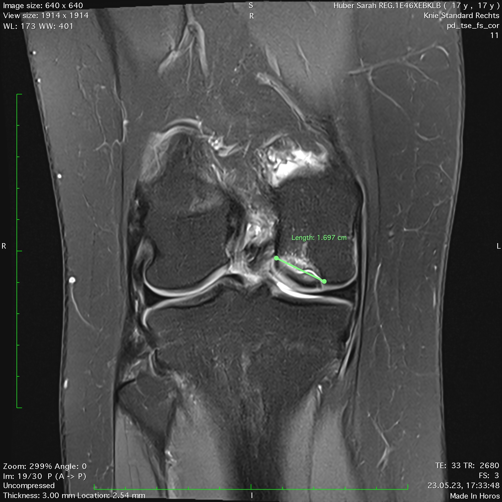 Osteochondritis dissecans | Orthopedist Vienna