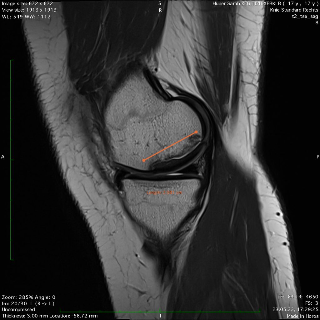 Case of the Week: Osteochondritis Dissecans