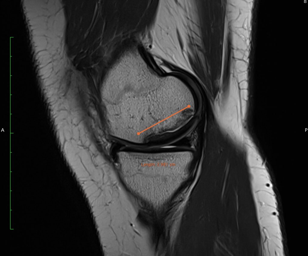 Case of the Week: Osteochondritis Dissecans